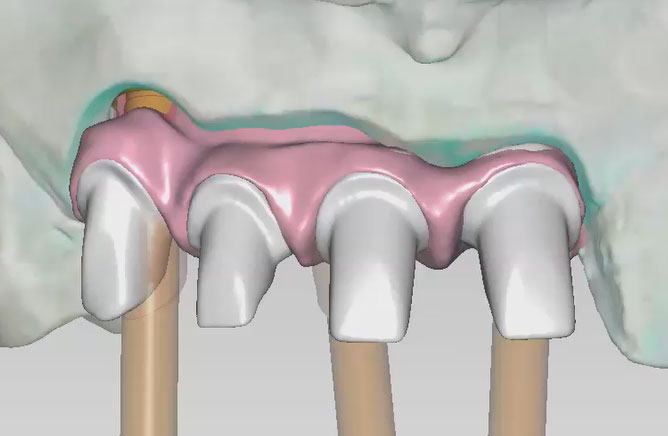 Implant Bridge — Soft Tissue with Thimble Design