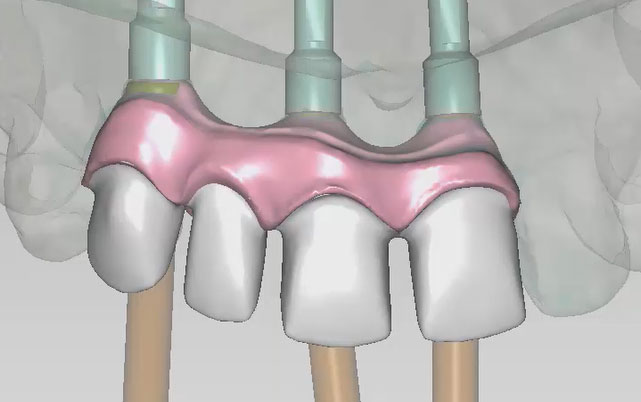Implant Bridge — Soft Tissue with Veneering Design