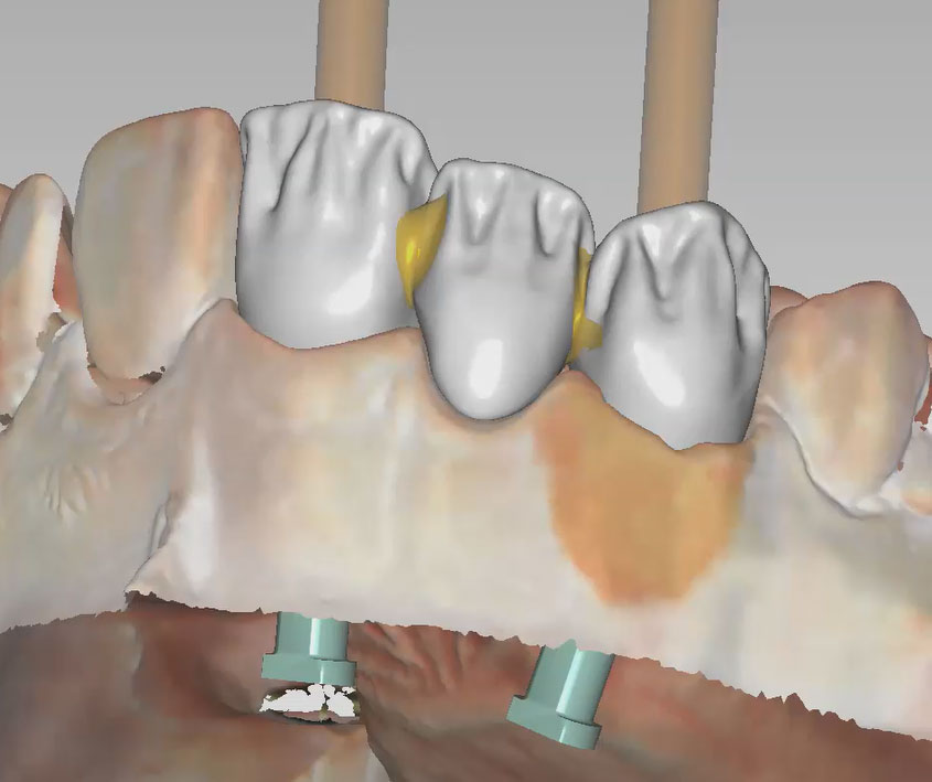 Implant Bridge with ASC and Facial Cutback