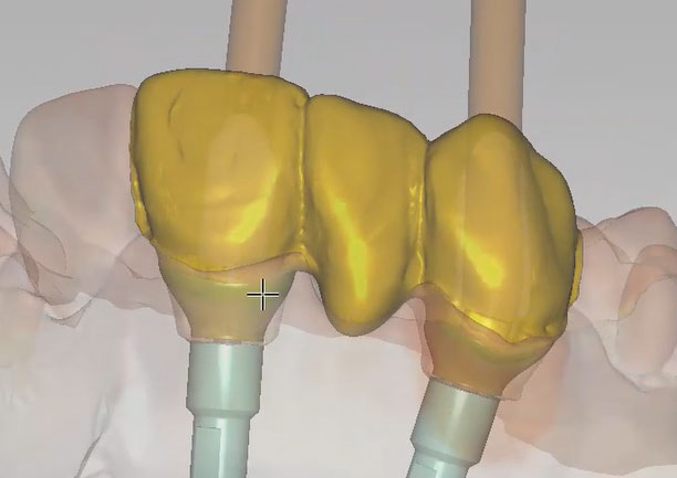 Implant Bridge — Designed from Diagnostic with Cutback
