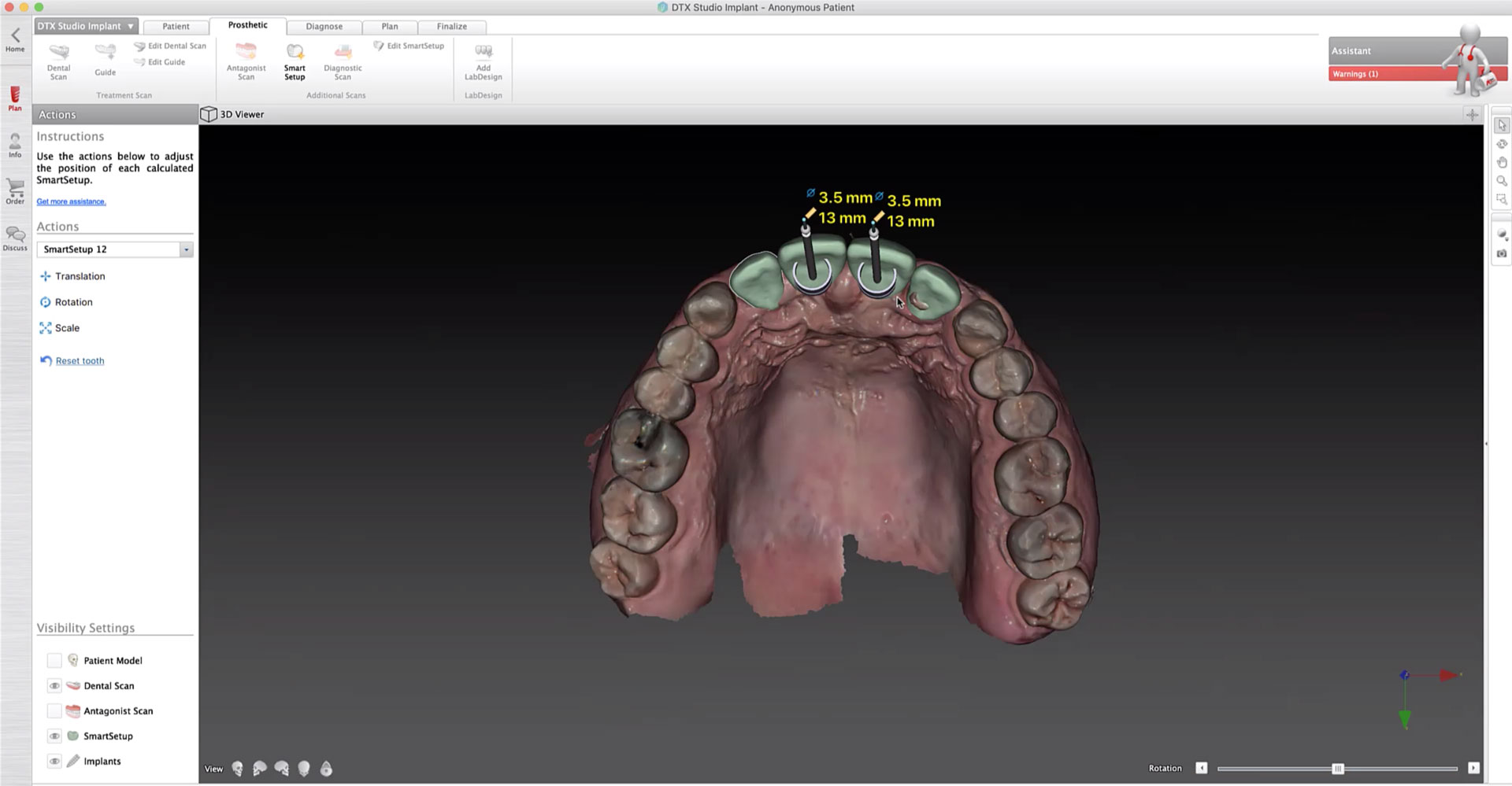 Create a Virtual Tooth Setup