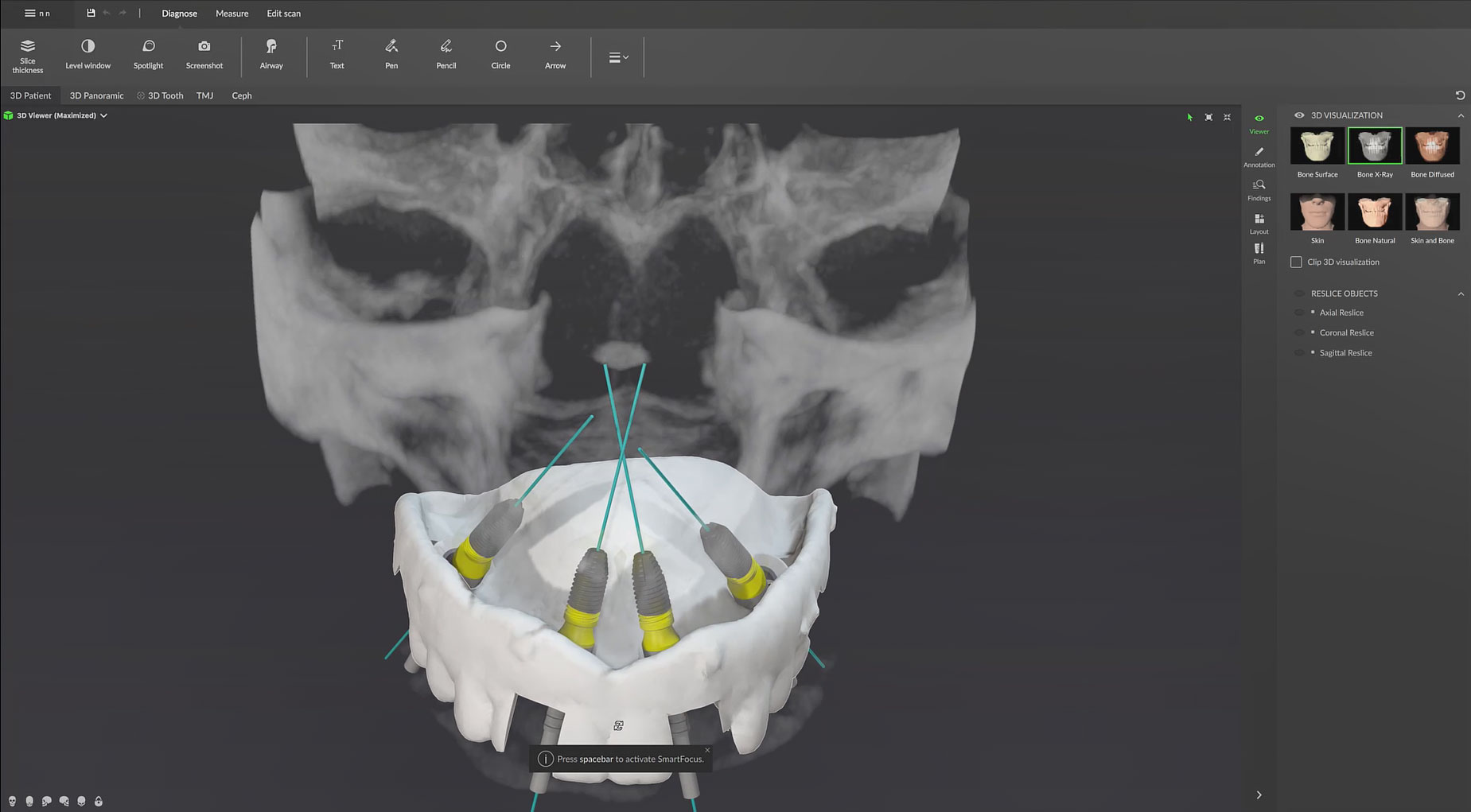 Export a Surgery Plan to DTX Studio™ Clinic
