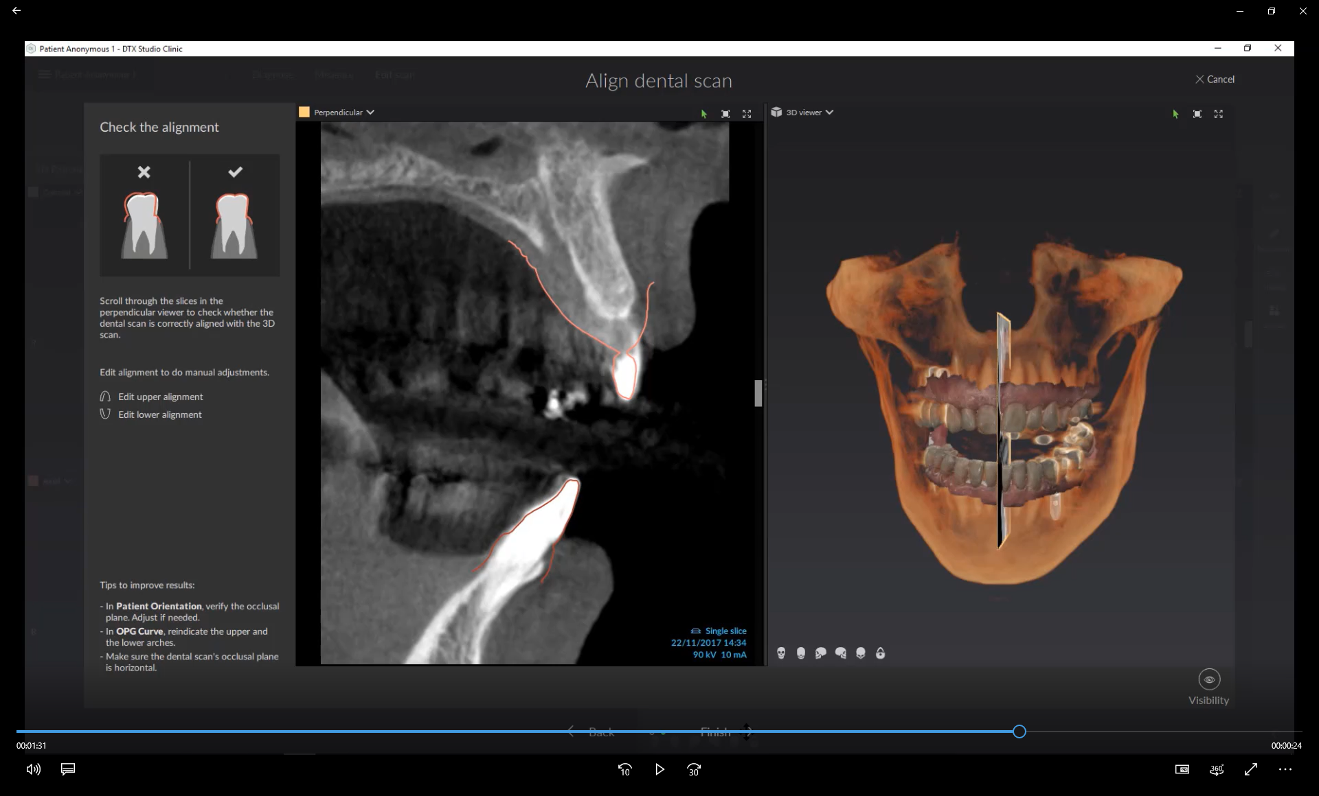 SmartFusion — Merge CBCT with Dental Scan