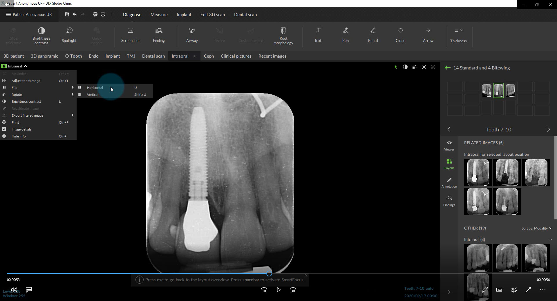 Mirror Intraoral X-Ray Images and Clinical Photos