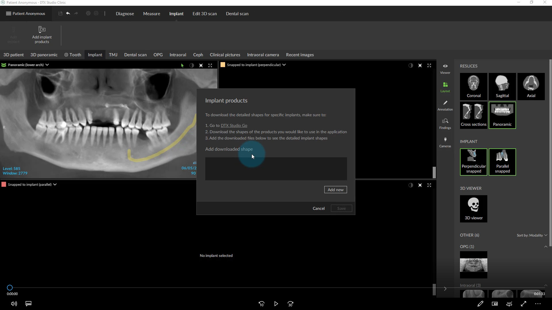 Adding Implant Libraries to DTX Studio™ Clinic