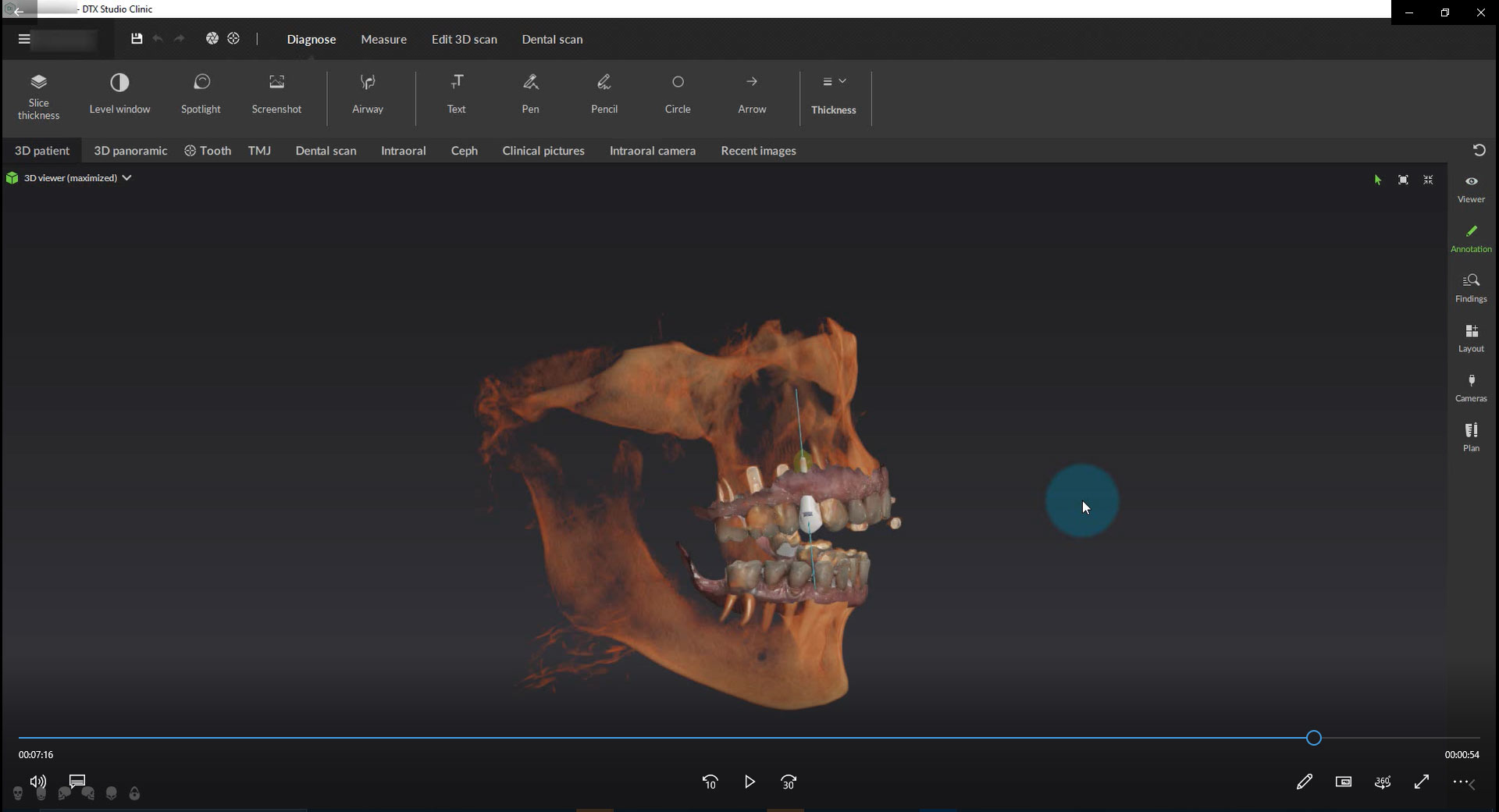 Use CBCT and Intraoral Scan for Implant Planning