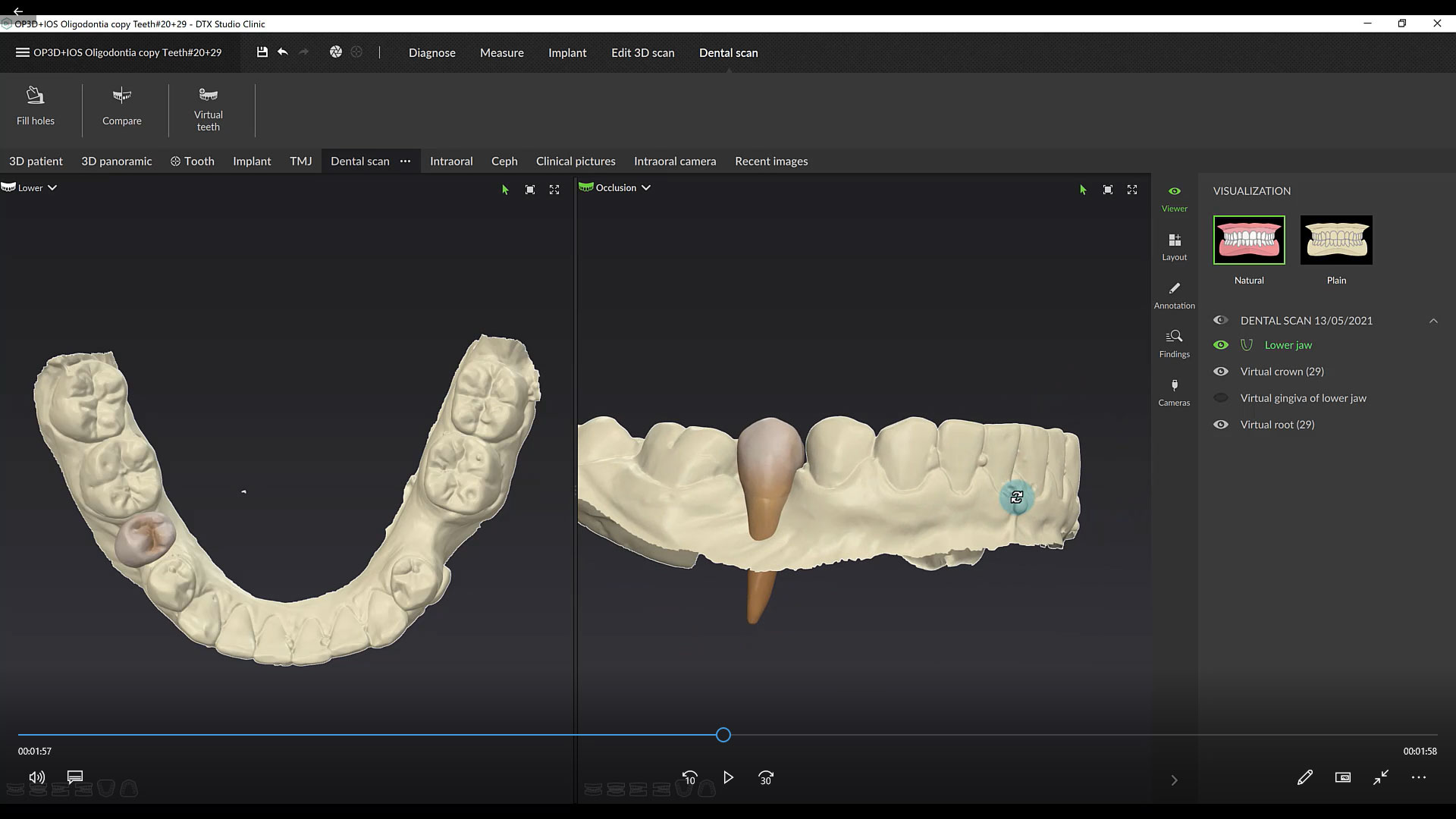 SmartSetup - Automatic Virtual Tooth Design
