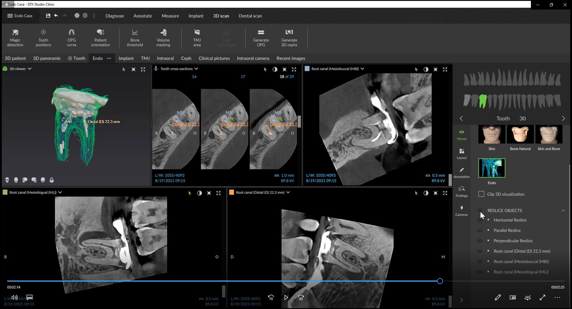 Read more about the article Endodontic Workspace with Morphology Annotations