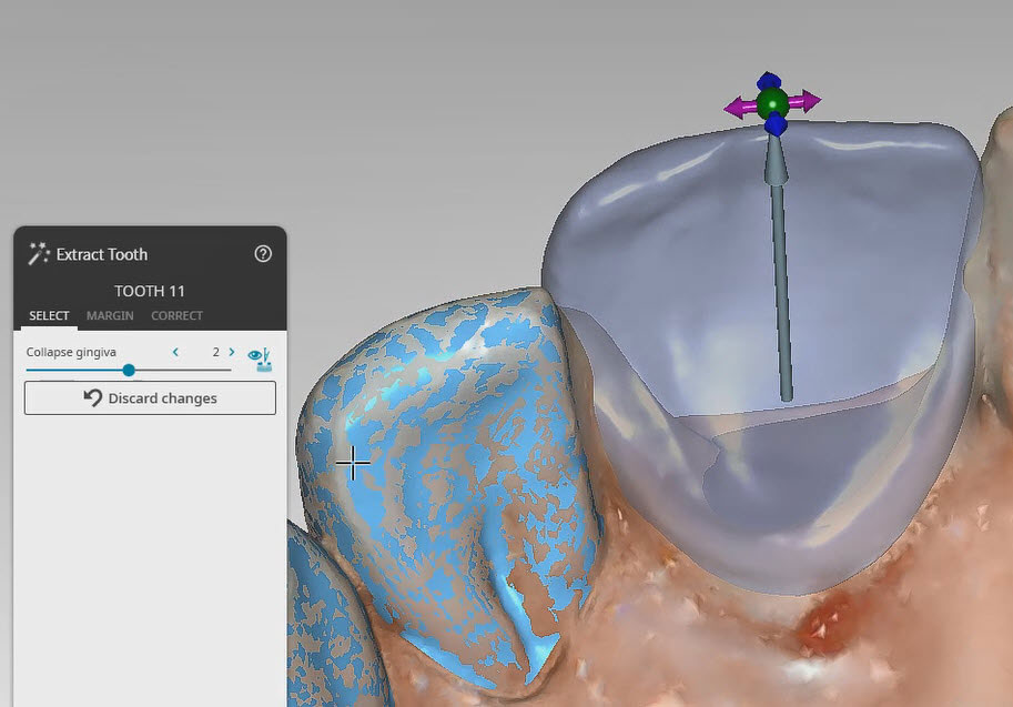 Virtual Tooth Extraction in the Provisional Module