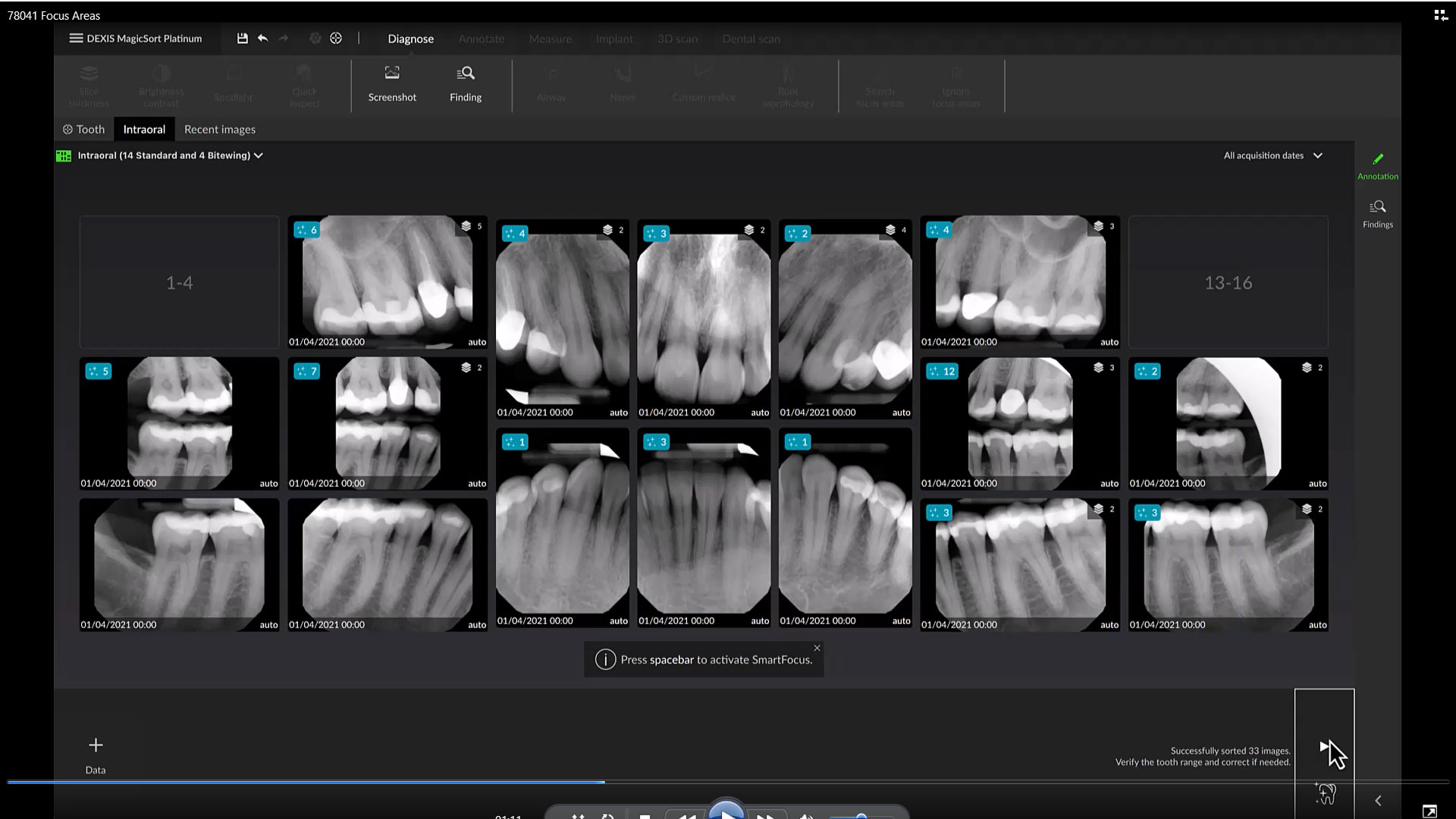 Automatic Detection of Dental Findings
