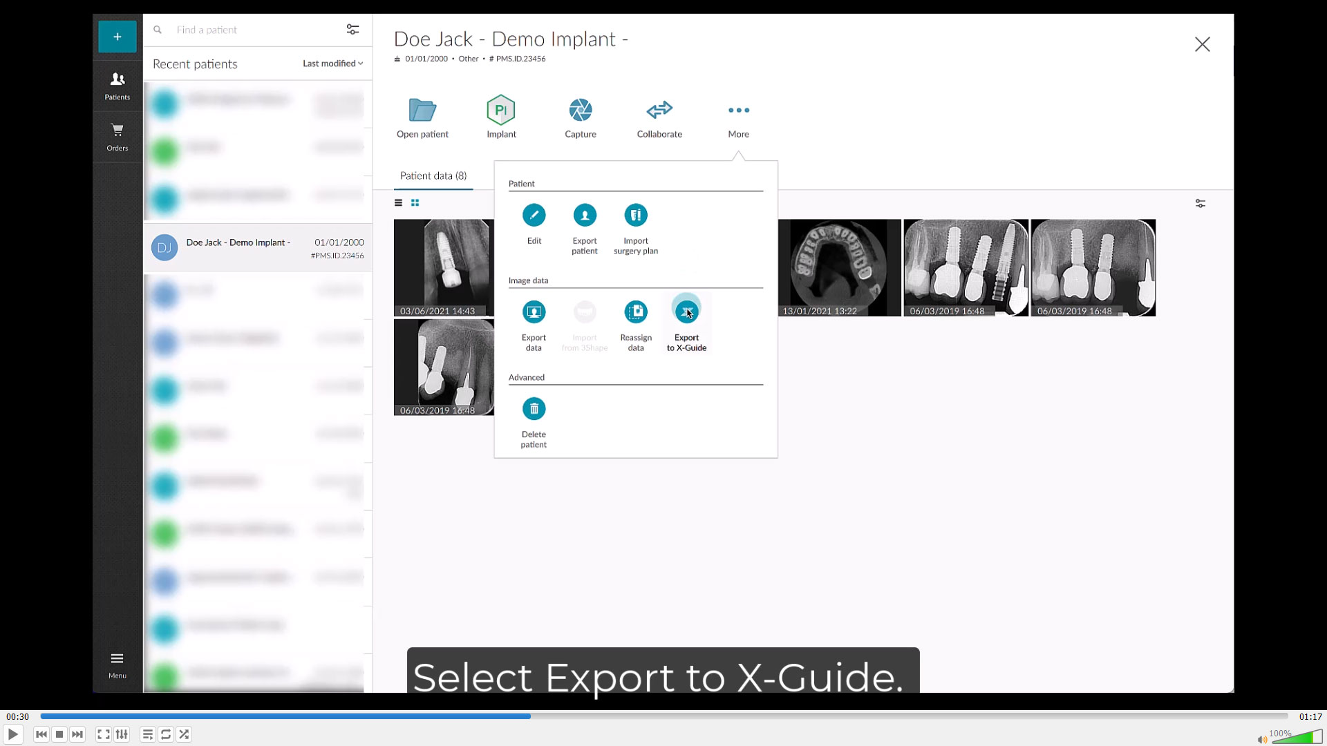 Export Treatment Planning to X-Guide