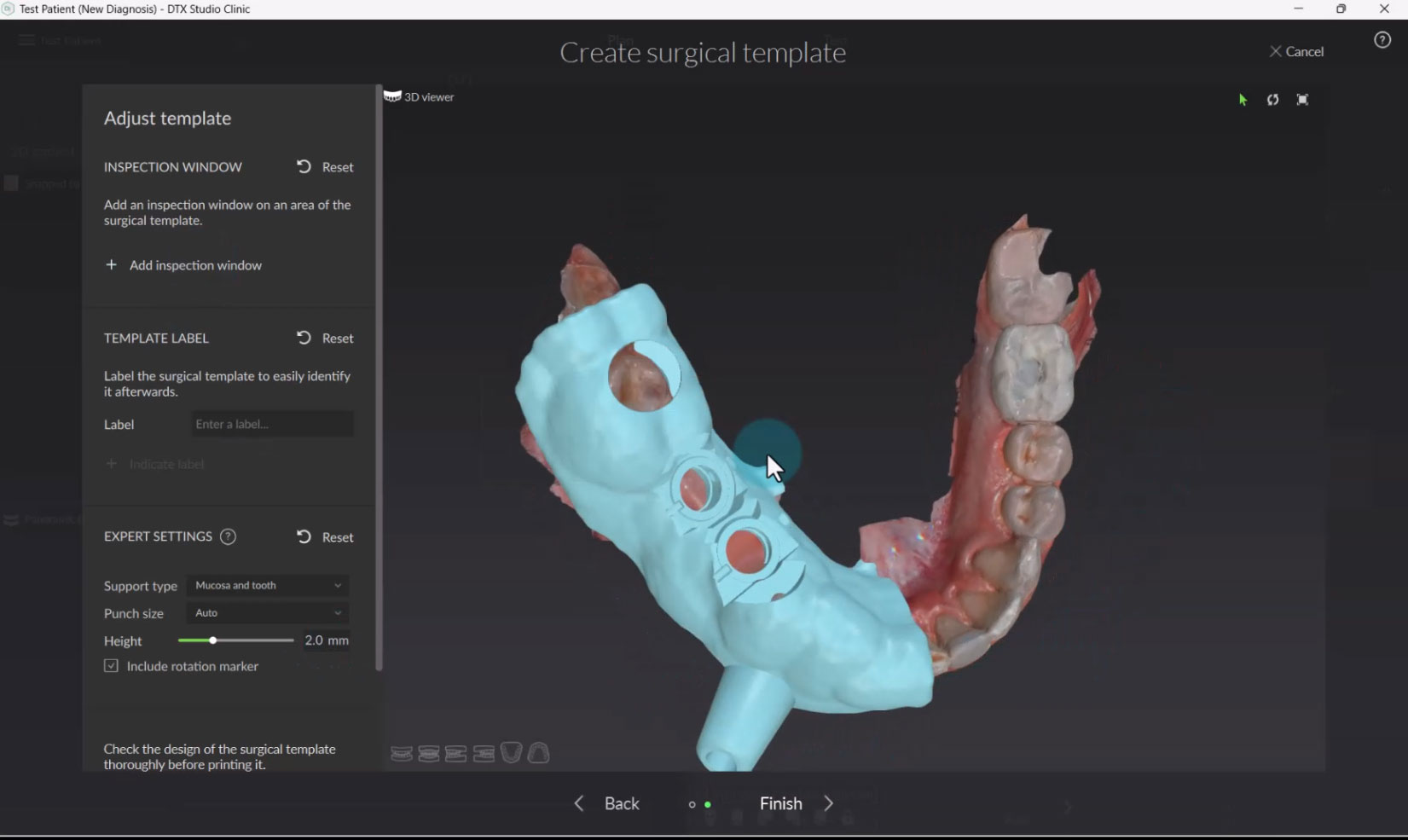 AI Powered Workflow for Surgical Templates