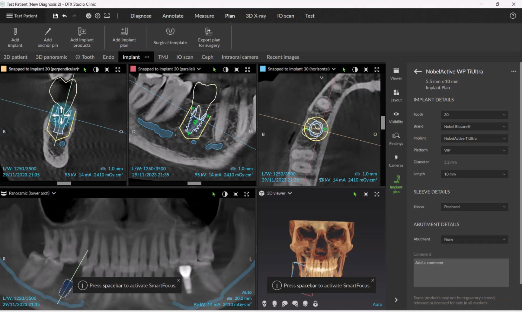 implant planning