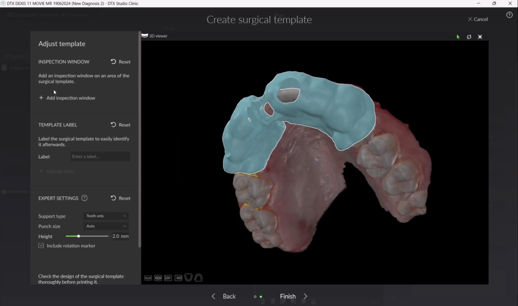 Create a Surgical Template for Local Production